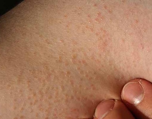 Tích tụ Keratin trên da là nguyên nhân chính dẫn đến bệnh lý dày sừng nang lông