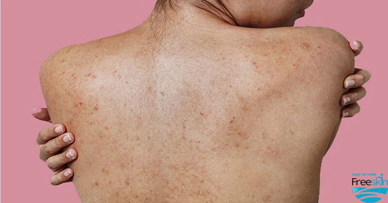 Vết thâm "cứng đầu" sau quá trình mụn