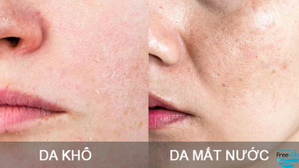 Phân biệt da khô và da mất nước